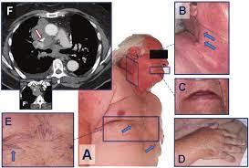Typical Clinical Findings In A Patient With Superior Vena Cava Syndrome Download Scientific Diagram