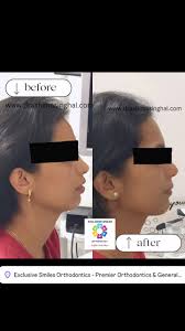 A case of severe crowding with proclined teeth treated with fixed ceramic  braces. , Happy patient 🙂, Happy me 🙂, ., ., ., #exclusivesmiles #kharadi  #kharadipune #orthodontics #braceslife ...