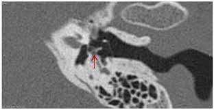 Image result for Ossicular Chain Disruption