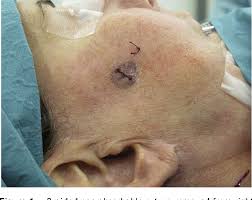 The patient was booked for an operation to remove the mass. Figure 2 From Braided Non Absorbable Sutures And Facelift A Cautionary Tale Semantic Scholar