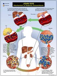Ketosis Vs Diabetic Ketoacidosis Diabetic Ketoacidosis Diabetes Education Nurse