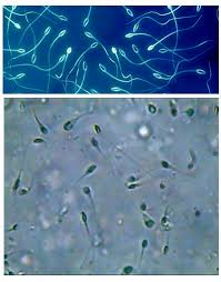 Esame del liquido seminale spermatozoi l'esame del liquido seminale, o spermiogramma, è l'indagine di laboratorio fondamentale a cui deve essere sottoposto. Nuovo S Orsola Spermiogramma