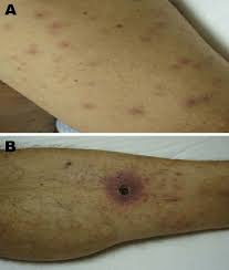 Maybe you would like to learn more about one of these? Evidence Of Acute Infection Of The Skin And Subcutaneous Tissue In Download Scientific Diagram