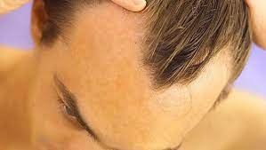 In fact, the international society of hair restoration surgery cites patients as young as 15 to 20 in what is known as early onset hair loss 4. At What Age Do Most Men With Male Pattern Baldness Start Balding Quora