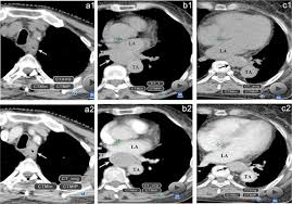 A ct scan can also look at joints and soft tissues, such as cartilage, muscles, and tendons. Effect Of Contrast Enhancement In Delineating Gtv And Constructing Igtv Of Thoracic Oesophageal Cancer Based On 4d Ct Scans Radiotherapy And Oncology