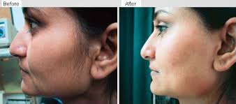 We did not find results for: Laser Hair Removal Hair Transplant Clinic Malaysia Dermatologist Malaysia