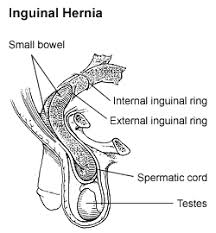 Image result for Inguinal hernia man