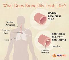 Image result for Acute Bronchitis