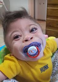 NOAH Mucolipidosis II