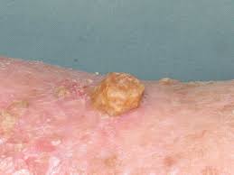 Image result for cornu cutaneum)