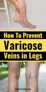 Pin On Varicose Veins Treatment How To Get Rid Of Essential Oils And Remedy