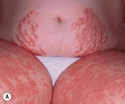 Image result for pruritic urticarial papules and plaques of pregnancy