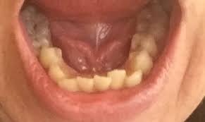 How To Fix A 'Wonky' Smile - Dr Gurs Sehmi