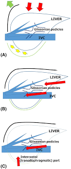 Laparoscopic and open liver resection were performed by experienced hepatobiliary surgeons. Developments And Perspectives Of Laparoscopic Liver Resection In The Treatment Of Hepatocellular Carcinoma Springerlink