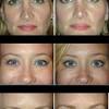 The bottom photo is months after getting botox. 3