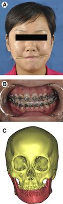 A, Preoperative frontal view of the patient. B, Frontal view of centric... 