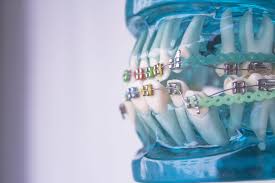 Your dentist or hygienist may give you they're both equally good, as long as you brush all the surfaces of all your teeth and you use fluoride toothpaste. Effects From Braces What S Normal What Isn T Blue Ridge Orthodontics