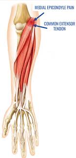 This video is for anyone that has pain in the inside of the elbow or forearm. Golfer S Elbow Treatment Perth Elbow Pain Cockburn Claremont Fremantle