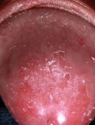 Image result for penis mycosis symptoms