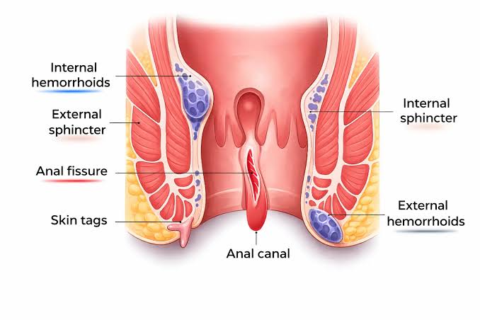 Anal Fissure Laser Treatment