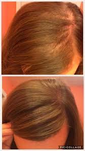 If lupus skin problems are causing your hair loss, your doctor can recommend medicines to treat your skin problems and help protect your hair. Customer Testimony Couldn T Be More Happy With How Monat Is Helping My Hair Grow In Hair Loss Remedies Hair Loss Women Hair Loss Treatment Vitamins