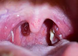 Bila aimi demam, mesti kena tonsil. Radang Tonsil Adakah Ia Boleh Mengakibatkan Kematian