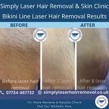 According to test and studies for a long time, 75% of hair grows slowly and reduces after 4 weeks with the laser. Simply Laser Hair Removal And Skin Clinic Simplylaserhair Twitter
