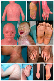 Image result for Ichthyosis