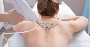 How much did your laser tattoo removal cost? Tattoo Removal Reno Nv Laser Tattoo Removal Reno Nv