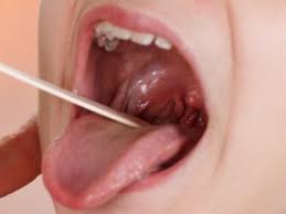 Brown phlegm that appears 'rusty' is often due to old blood in the mucus, which can occur. Ear Nose And Throat Ent Northern Lincolnshire And Goole Nhs Foundation Trust Northern Lincolnshire And Goole Nhs Foundation Trust