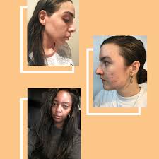 Is it time to see a dermatologist for my acne? Dermatica Online Dermatologist Review Acne Melasma