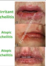 Mouth Lip Eczema Triggers How To Get Ride Of Eczema Around The Lips Mouth Eczema Triggers Eczema Lips