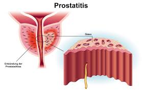 Prostataentzundung Prostatitis Ursache Symptome Behandlung Ksw