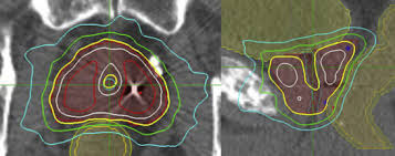 Once a tumor causes your prostate gland to swell, or once cancer spreads beyond your prostate, you may have symptoms including: Retreatment For Local Recurrence Of Prostatic Carcinoma After Prior Therapeutic Irradiation Efficacy And Toxicity Of Hdr Like Sbrt International Journal Of Radiation Oncology Biology Physics