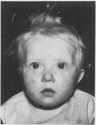 A Patient with 45,XX,G-/46,XX,Gr Mosaicism