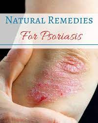 Home Remedies For Psoriasis My Favthings Psoriasis Remedies Natural Psoriasis Remedies Psoriasis