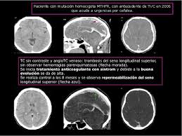 Maybe you would like to learn more about one of these? Revision De La Trombosis Venosa Cerebral Diagnostico Tratamiento Y Evolucion Clinicoradiologica Semantic Scholar