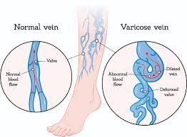 Varicose Veins Dallas Fort Worth Varicose Veins