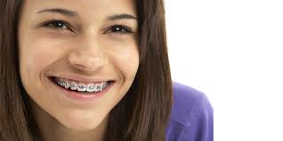 Buongiorno, sono portatore di apparecchio ortodontico da più di un anno, e non avendo mai avuto buonasera.ho 28anni e sto valutando l apparecchio ortodontico per correggere la mia dentatura. Apparecchio Denti Fisso In Metallo Milano Bergamo Dr Cacciatore