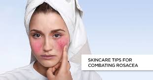 Picking the right products is very important for avoiding flareups and irritation. What Is Rosacea Symptoms Complications And Treatment