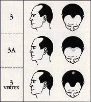 Norwood Hamilton Scale How To Measure Your Hair Loss His