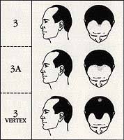 norwood hamilton scale how to measure your hair loss his