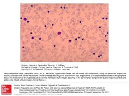 It helps shrink the cancer and increases the effectiveness of radiation therapy. An Algorithm For Prostate Cancer Early Detection Ppt Download