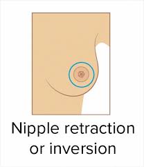 Breast cancer is also the. These 9 Pics Showing The Common Signs Of Breast Cancer Are A Must See For Everyone Bored Panda