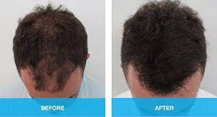 12 months kirkland extra strength men hair loss regrowth 5% minoxidil 10/2022. Hair Loss Treatments For Men Gold Coast Brisbane Medici Capelli