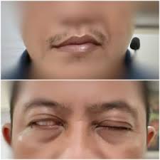 Jan 07, 2021 · bell's palsy. Bell S Palsy Bisa Sembuh Ini Pengalaman Suami Saya