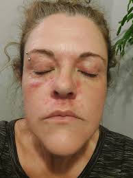 Treatment for yeast rash from silicone mask?