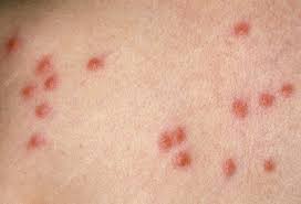 Image result for Papular urticaria