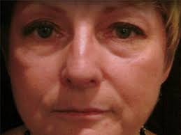 Laser Resurfacing in Reno, Sparks & Hidden Valley, NV Reno NV