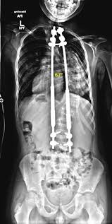 How long does scoliosis surgery take. Pediatric Scoliosis Surgical Technologies Growing Rods